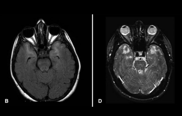 Cada cuatro minutos muere una persona en el mundo por infarto cerebral