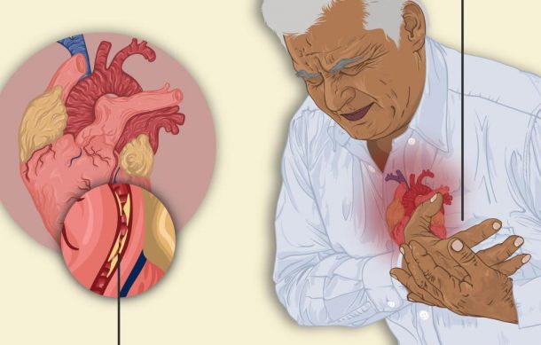 El estrés aumenta  los riesgos de infarto: hospitales civiles