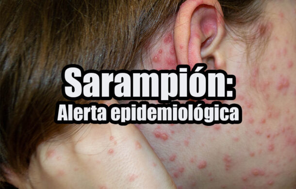 Sarampión: Alerta epidemiológica