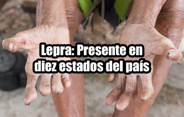 Lepra: Presente en diez estados del país