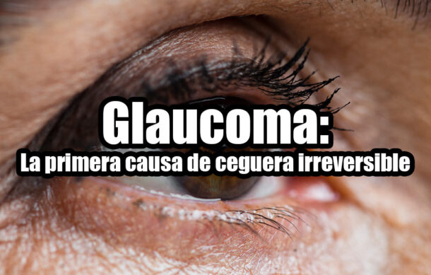 Glaucoma: La primera causa de ceguera irreversible